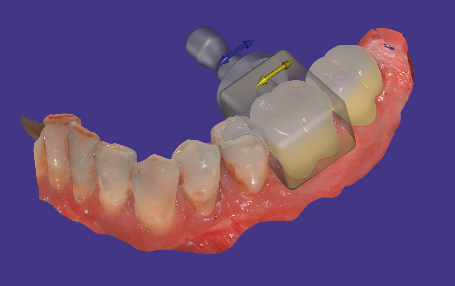 exocad Nesting Modul